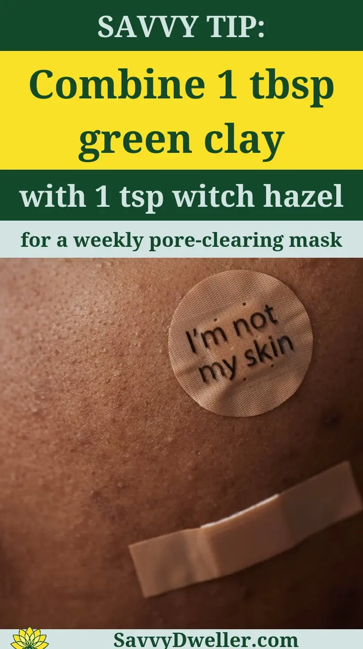 Natural remedy for hormonal acne along the jawline using green clay and witch hazel.